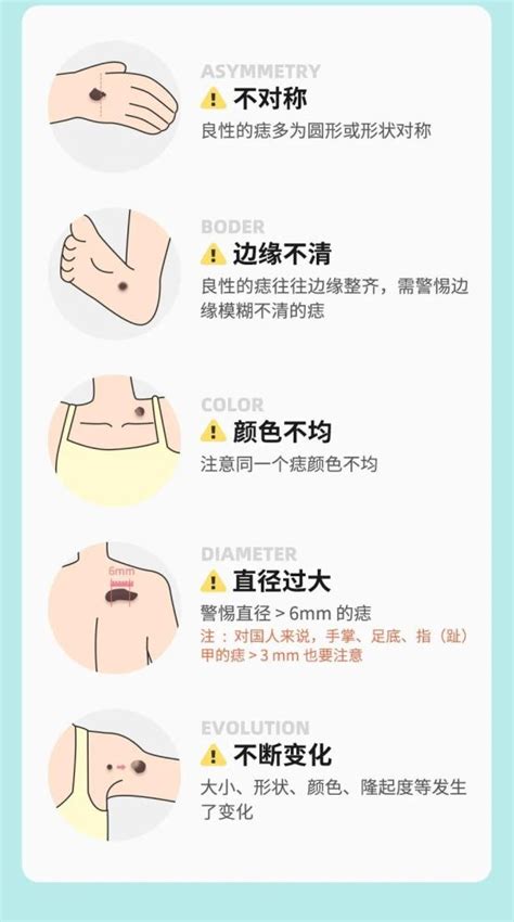 手掌後天長痣|痣也可能会癌变！长在 3 个地方要注意